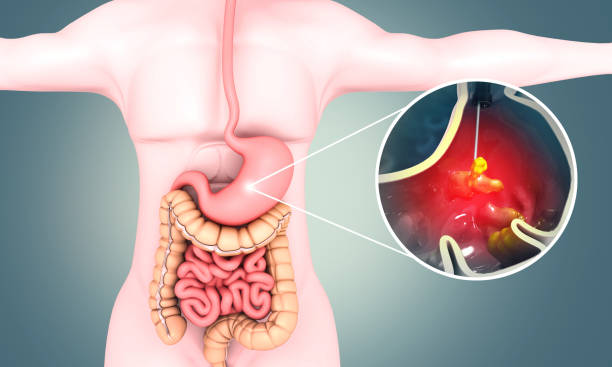 ulcer diagnosis and treatment