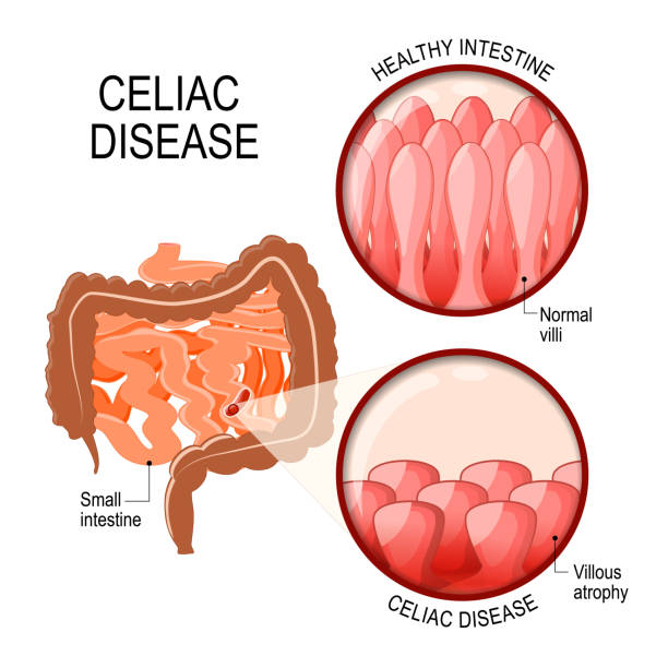 Celiac Disease Causes Symptoms Birla Hospital